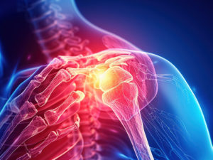 Tout savoir sur les délicates pathologies de l’épaule